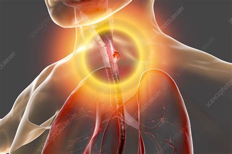 Oesophageal Cancer Illustration Stock Image F0267943 Science
