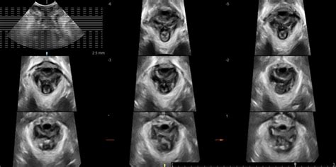 Tomographic Ultrasound Imatge Tui Showing The Normal Appearance Of