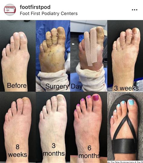 Worth The Results 👣💥 Hammer Toe Surgery Hand Foot And Mouth Podiatry