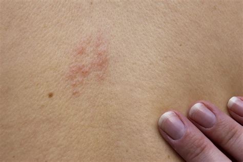 Itchy Skin Causes And Symptoms