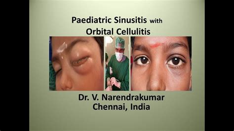 Paediatric Sinusitis With Orbital Cellulitis Dr V Narendrakumar