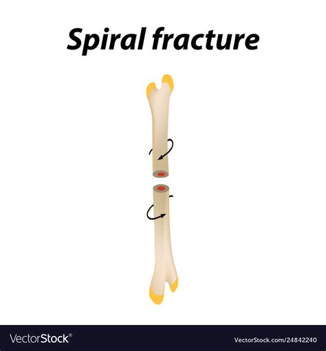Spiral Bone Fracture Infographics Royalty Free Vector Image