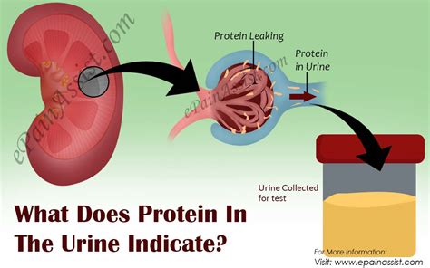 Urinary blood that's visible only under a microscope (microscopic hematuria) is found when your doctor tests your urine. What Does Protein In The Urine Indicate?