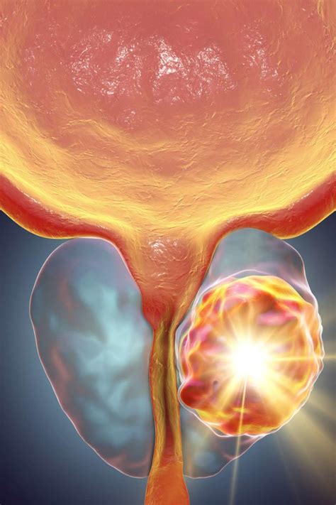 Feeling like you have a safe, supportive home life is also crucial to your emotional centeredness. Aggressive cancer what does it mean, Aggressive cancer in ...