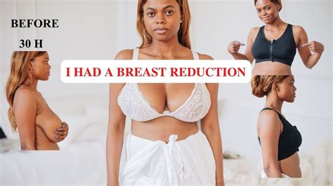 I G T A Breast Reduction Lift My Results Dadouchic Youtube