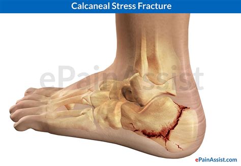 Calcaneal Stress Fracturecausessymptomstreatment Heel Pad Plaster