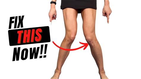 How To Fix Knock Knees With Exercise