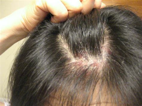 If You Are Also Suffering From Scalp Scabs Then There Is Nothing To