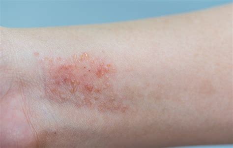 Ease Your Itchy Skin With These 8 Best Eczema Treatments Prevention