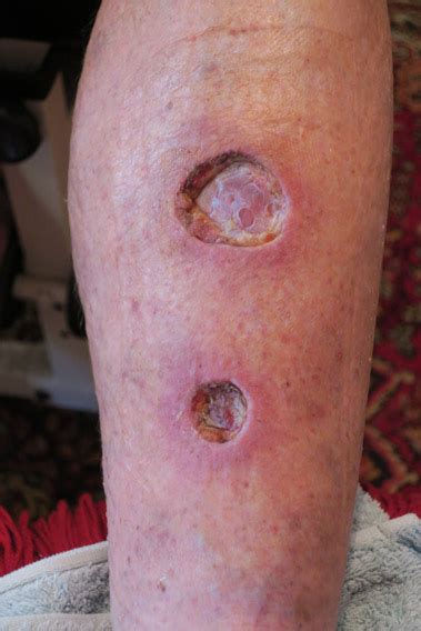 Basal Cell Carcinoma Not So Serious Think Again • The Boomtown Rap