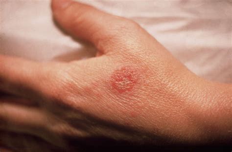 Discoid Eczema 10 Symptoms Of Discoid Eczema