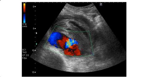 Doppler Ultrasound Of The Right External Iliac Artery Showing A 106 ×