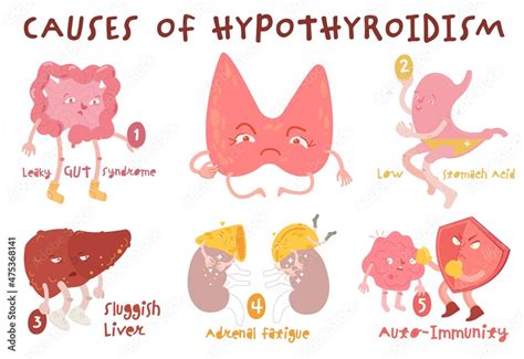 Causes Of Hypothyroidism Thyroid Gland Disease Endocrine System