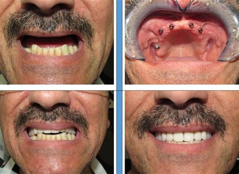 Implantes dentales (antes y después) en 2020 | Implantes dentales