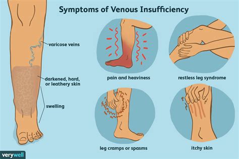 Venuous Insufficiency Symptoms Causes And Treatment