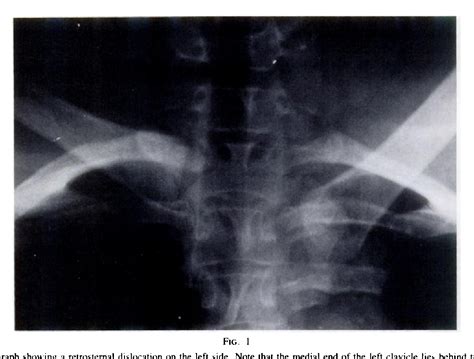Figure I From Acute Traumatic Retrosternal Dislocation Of The Clavicle