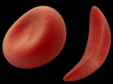 Sickle cell disease causes and risk factors. World Sickle Cell Day 2014: Why Raising Awareness About ...