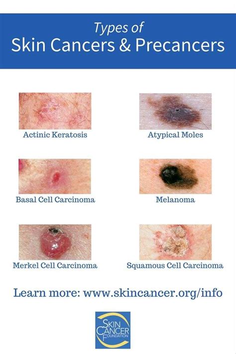 What Does Different Types Of Skin Cancer Look Like