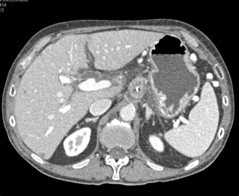 Pancreatic Adenocarcinoma With Vascular Invasion And Liver Metastases