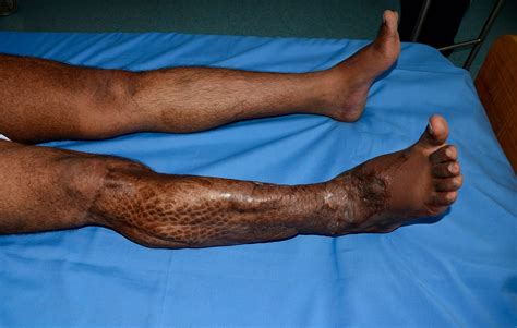 Major Circumferential Degloving Injury Leg Negative Pressure Wound