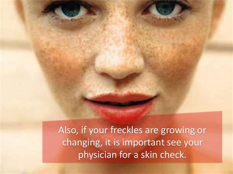 How To Get Rid Of Freckles Treatment Options For Freckle Removal