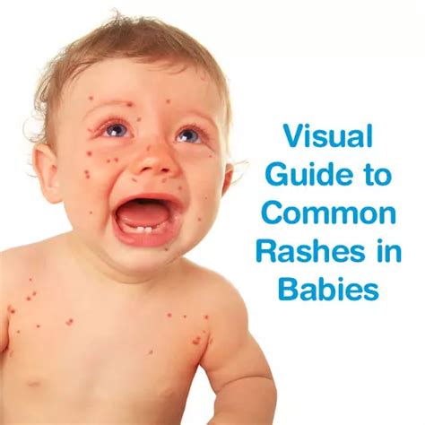 Common Newborn Rashes Healthy Momandbaby