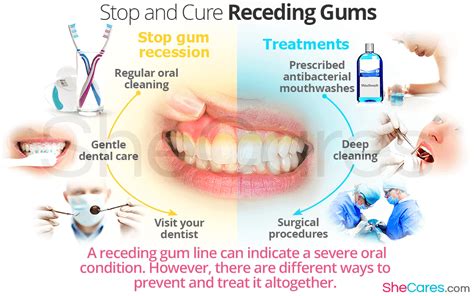 Receding Gums Stages