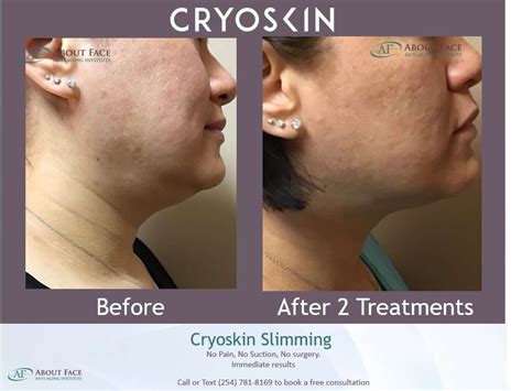 Cryoskin Slimming Treatment Before And After About Face