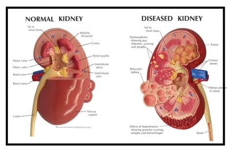 Chronic Kidney Disease | ELIM RHEUMATIC CENTRE