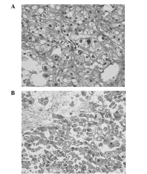 Mediastinal Lymph Node Metastasis Of Renal Cell Carcinoma A Case Report