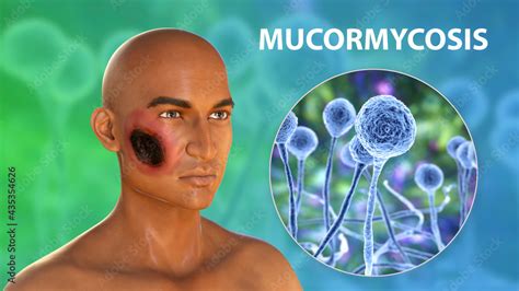 Cutaneous Mucormycosis Or Skin Mucormycosis A Disease Caused By Fungi