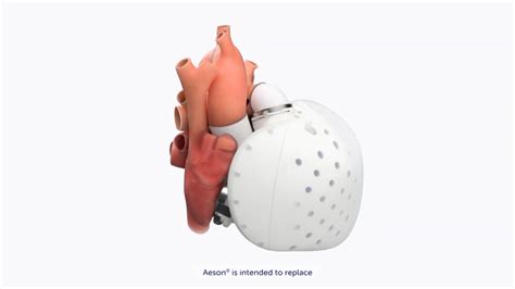 Se Realiza El Primer Implante De Corazón Artificial Humano Aeson En Los