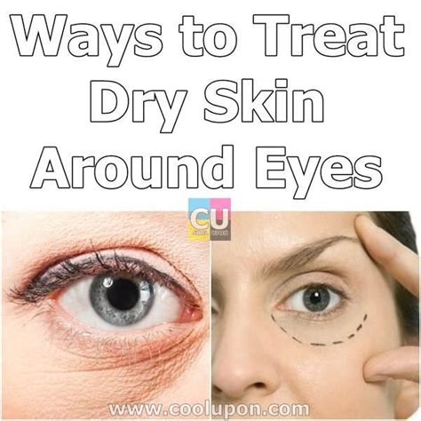 10 Ways To Treat Dry Skin Around Eyes Dry Skin Around Eyes Dry