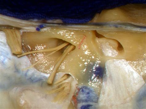 Medial Petrous Bone Anatomy | Neuroanatomy | The Neurosurgical Atlas