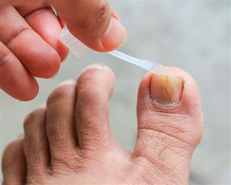 Ingrown Toenail And Fungal Nail Treatment Podiatrist — Foot And Ankle Center Of New Jersey And New