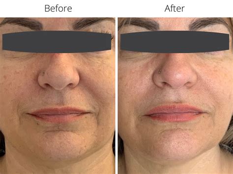 Marionette Lines Treatments With Dermal Fillers Or Botox Melior Clinics