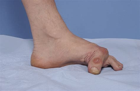 The Treatment Of Severe Flexion Contracture Of The Great Toe In A