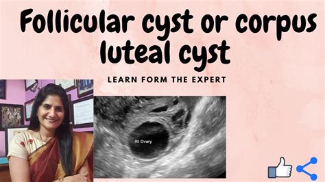 What Is Follicular Cyst What Is Corpus Luteal Cyst Ovariancyst