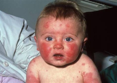 Visual Guide To Childrens Rashes And Skin Conditions Fifth Disease
