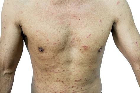 Drugs That Can Cause Life Threatening Skin Rashes The Peoples Pharmacy