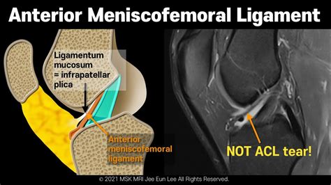 Anatomy Anterior Meniscofemoral Ligament Anomalous Insertion Of The Medial Meniscus YouTube