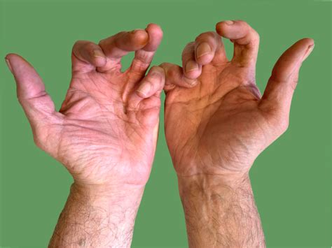 Dupuytrens Disease Aberdeen Virtual Hand Clinic