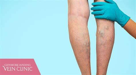 How To Prepare For Sclerotherapy Varicose Vein Treatment