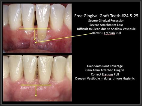 Gum Grafting Huntington Beach Cosmetic Periodontics Dr Braga