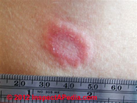 Scalp infections occur when bacteria or fungus enter damaged skin or hair follicles on the scalp. Morgellons Disease or Morgellon's Syndrome: fibers, dust ...
