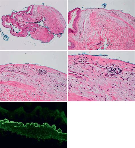 Pathology Images Of A Bullous Lesion A Hande Magnification ×10 B Hande