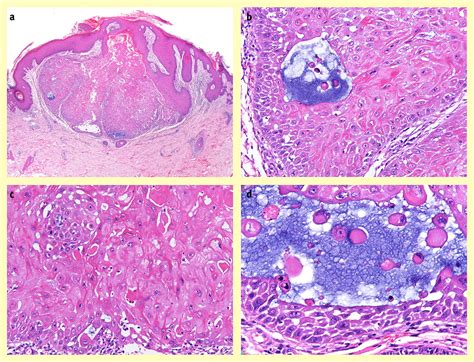 Follicular Squamous Cell Carcinoma Is An Under Recognised Common Skin