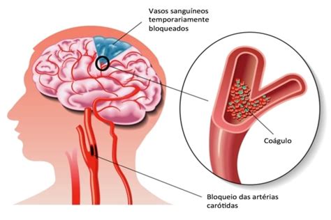 Isquemia Cerebral Causas Sintomas Consequências e Tratamentos