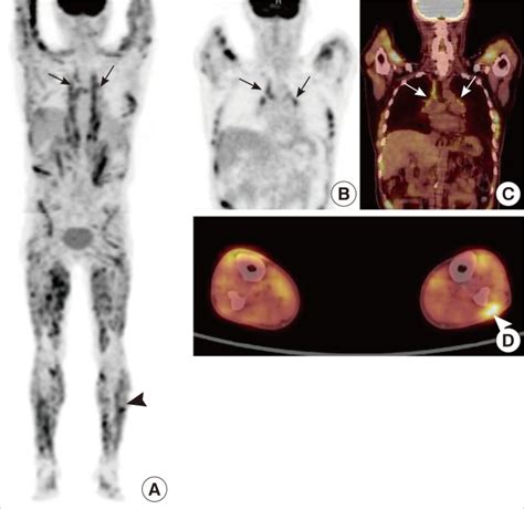 F 18 Fdg Petct Findings In Maximum Intensity Projection Mip A And