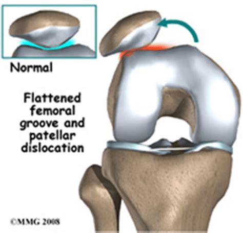 Video Patellar Dislocation And Surgical Decision Making Howard J